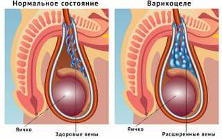 Варикоцеле у мужчин: причины, симптомы и лечение