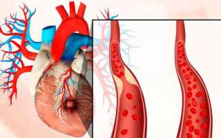 Причины и лечение ишемии (ischemia) сердечной мышцы