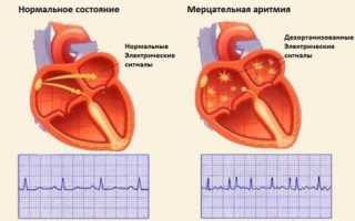 Лечение мерцательной аритмии сердца народными средствами