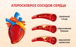 Причины возникновения аортосклероза сердца и методы лечения