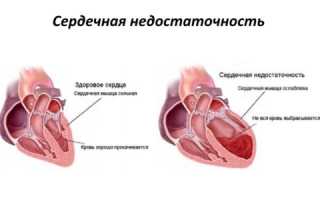 Лечение одышки при сердечной недостаточности лекарствами и народными средствами