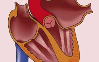 Признаки и лечение дилатации камер сердца
