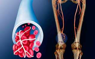 Чем лечить артериальный тромбоз нижних конечностей
