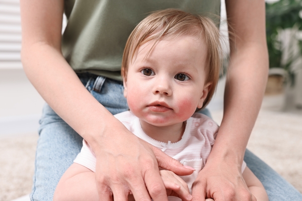 Photo of Как избежать аллергических реакций